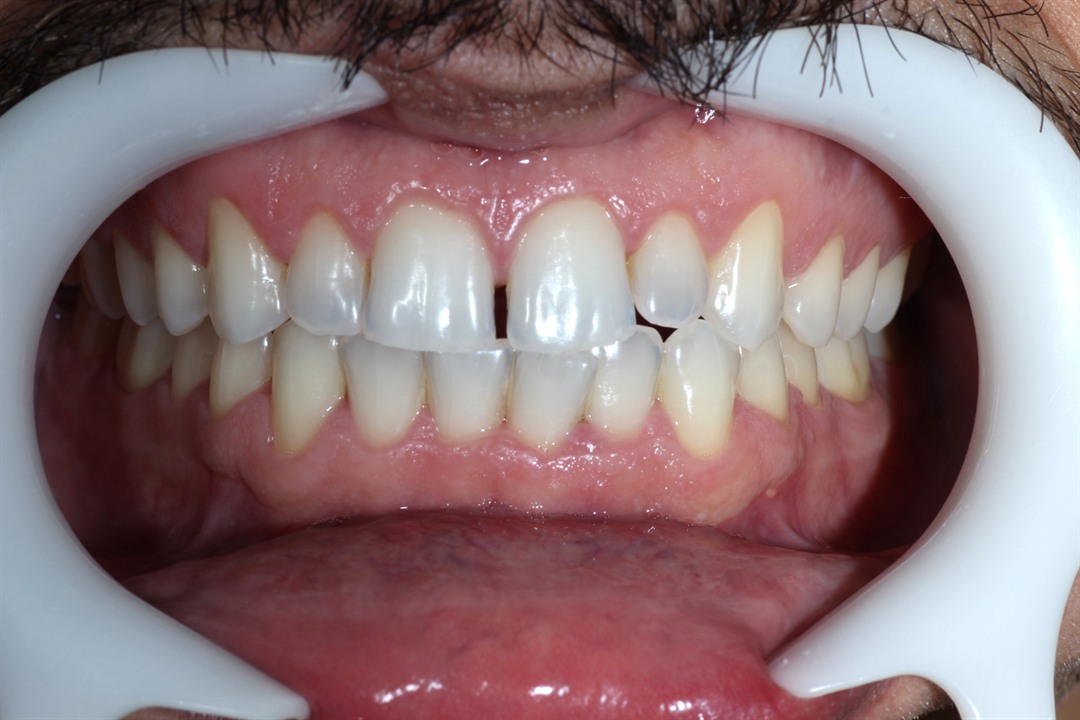 Sorriso depois do clareamento dental